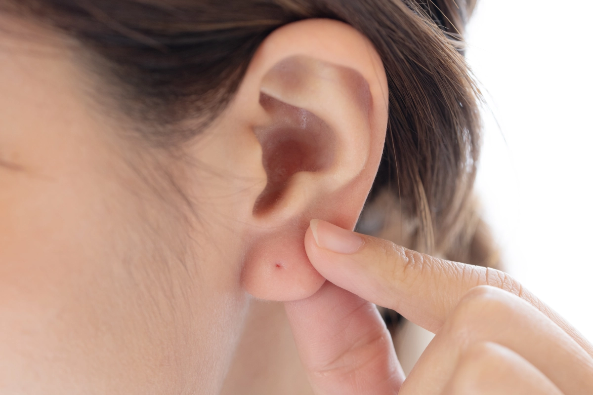 医療ピアッシング