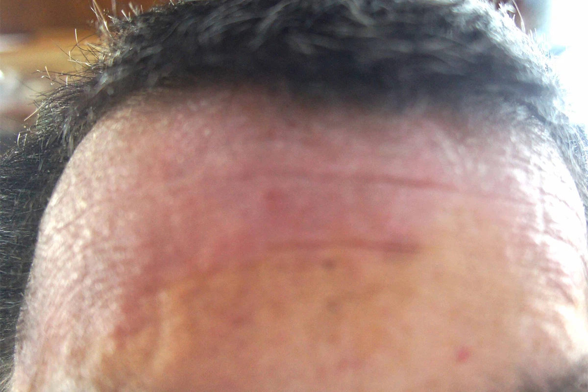 アトピー性皮膚炎