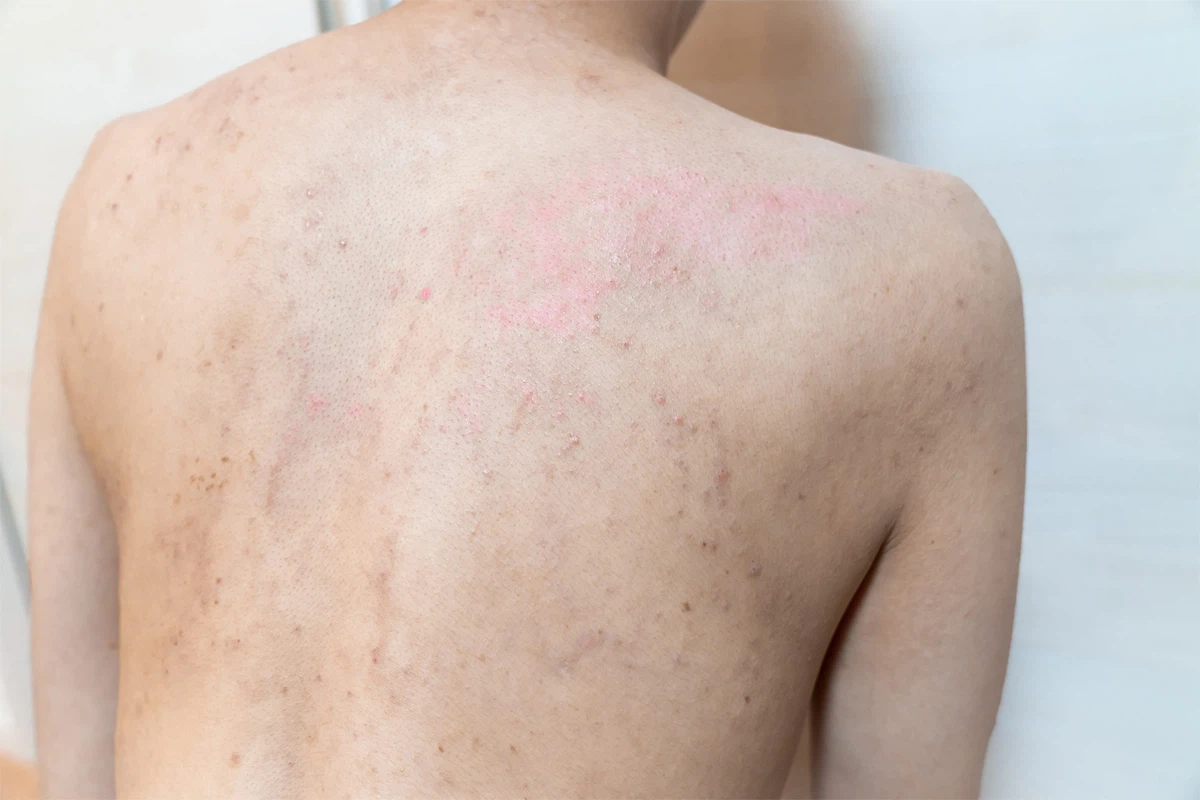 アトピー性皮膚炎