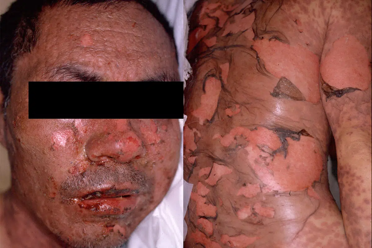 抗てんかん薬によるTEN型