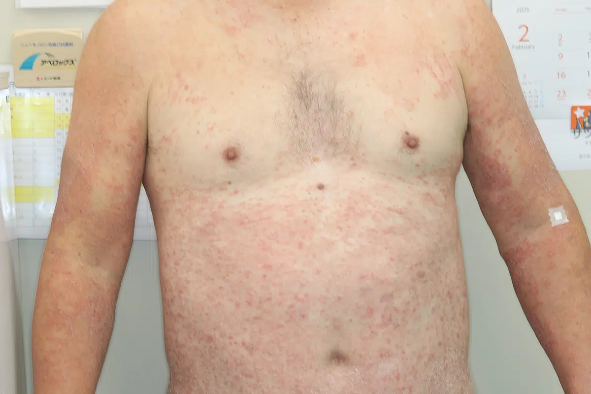 高脂血症薬による播種状紅斑丘疹型