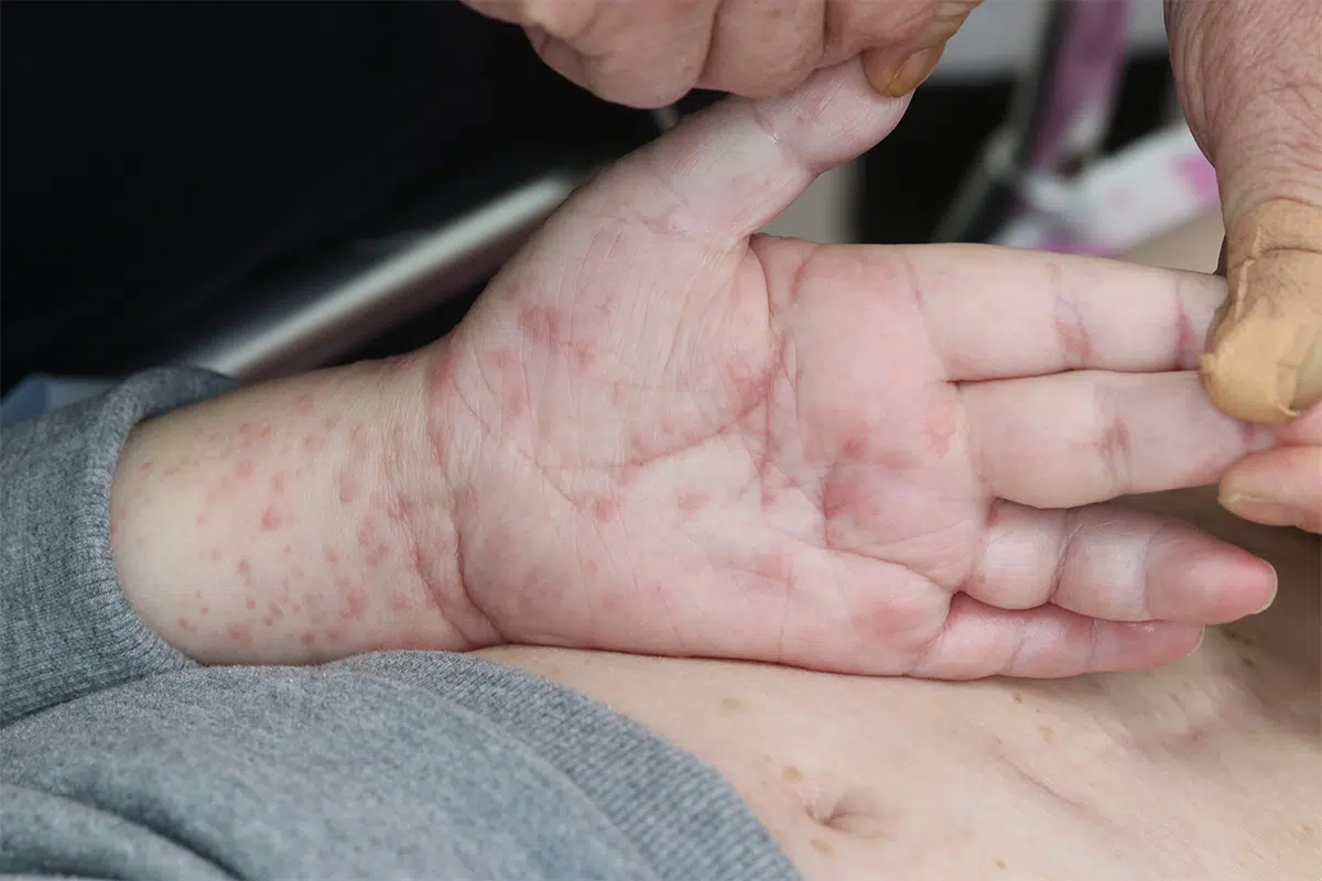 胃潰瘍薬が原因の多型紅斑型（中央に水疱をもつ紅斑が多発）