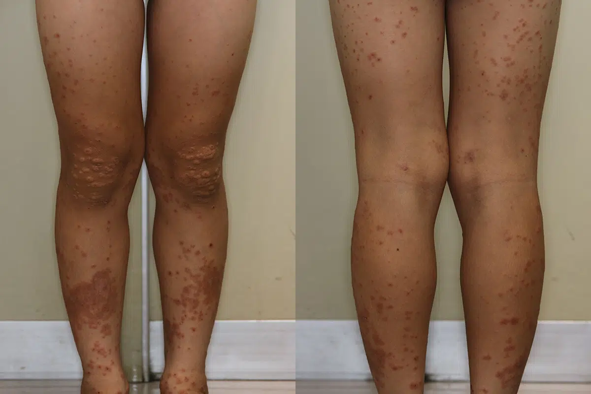 低亜鉛血症薬による多型紅斑型（小さなターゲット状紅斑が多発）