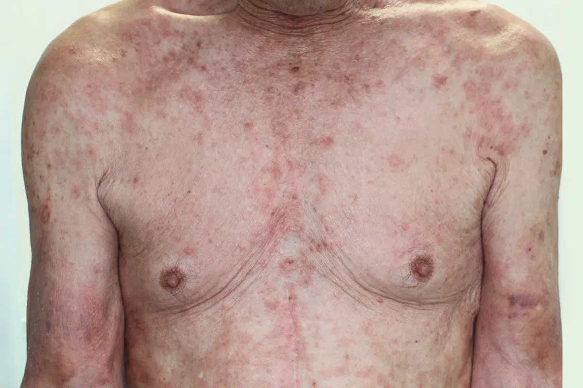 降圧剤による扁平苔癬型（罹病期間が長く外用剤の副作用も併発）