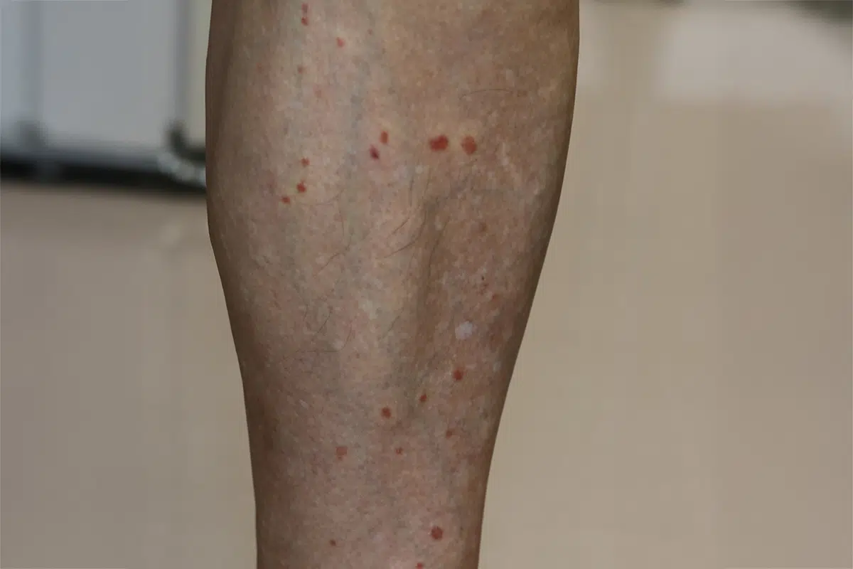 降圧剤（ACE阻害薬）による扁平苔癬型