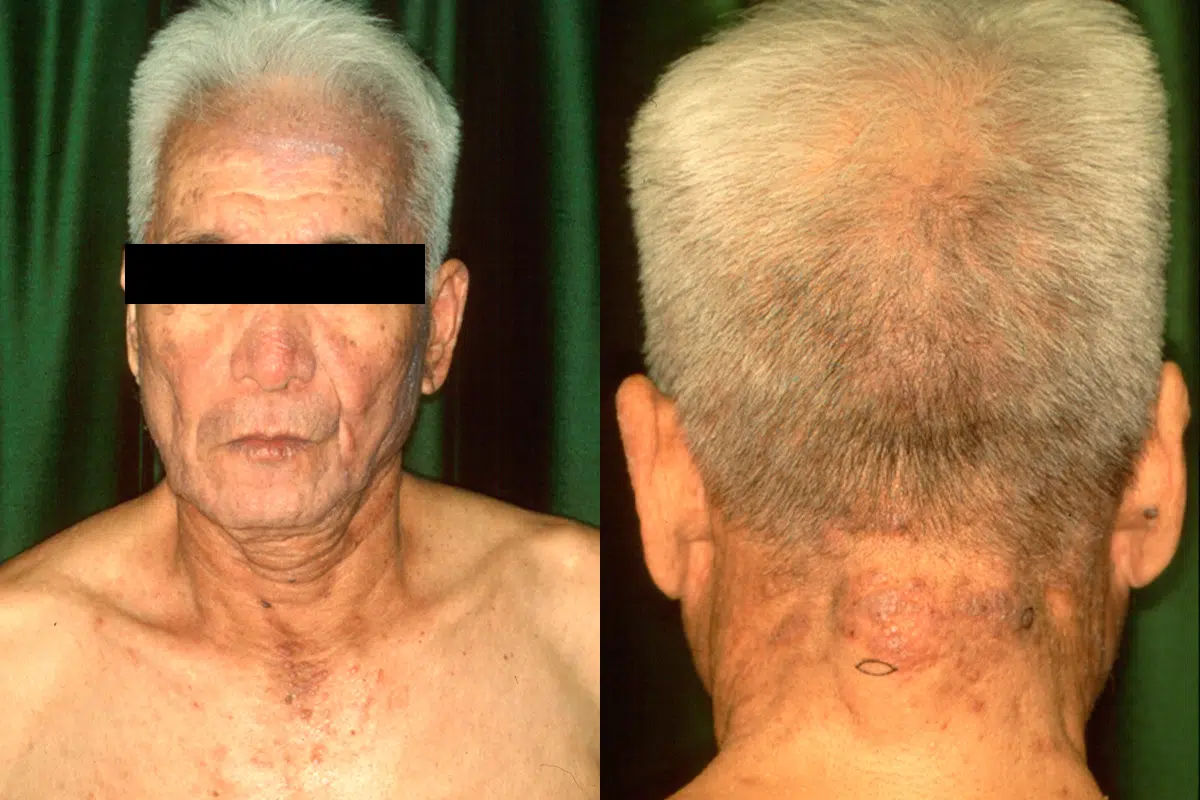 利尿薬による光線過敏型