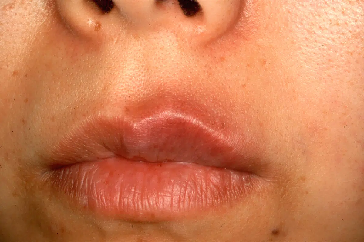 鎮痛薬（NSAIDs）による固定薬疹型